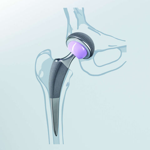 cementfree hip replacement