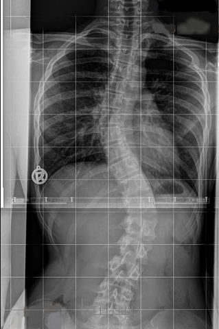 scoliosis x ray