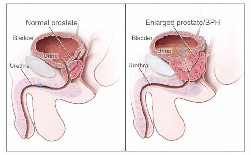 Cât costă chirurgia adenomului de prostată cu un laser verde