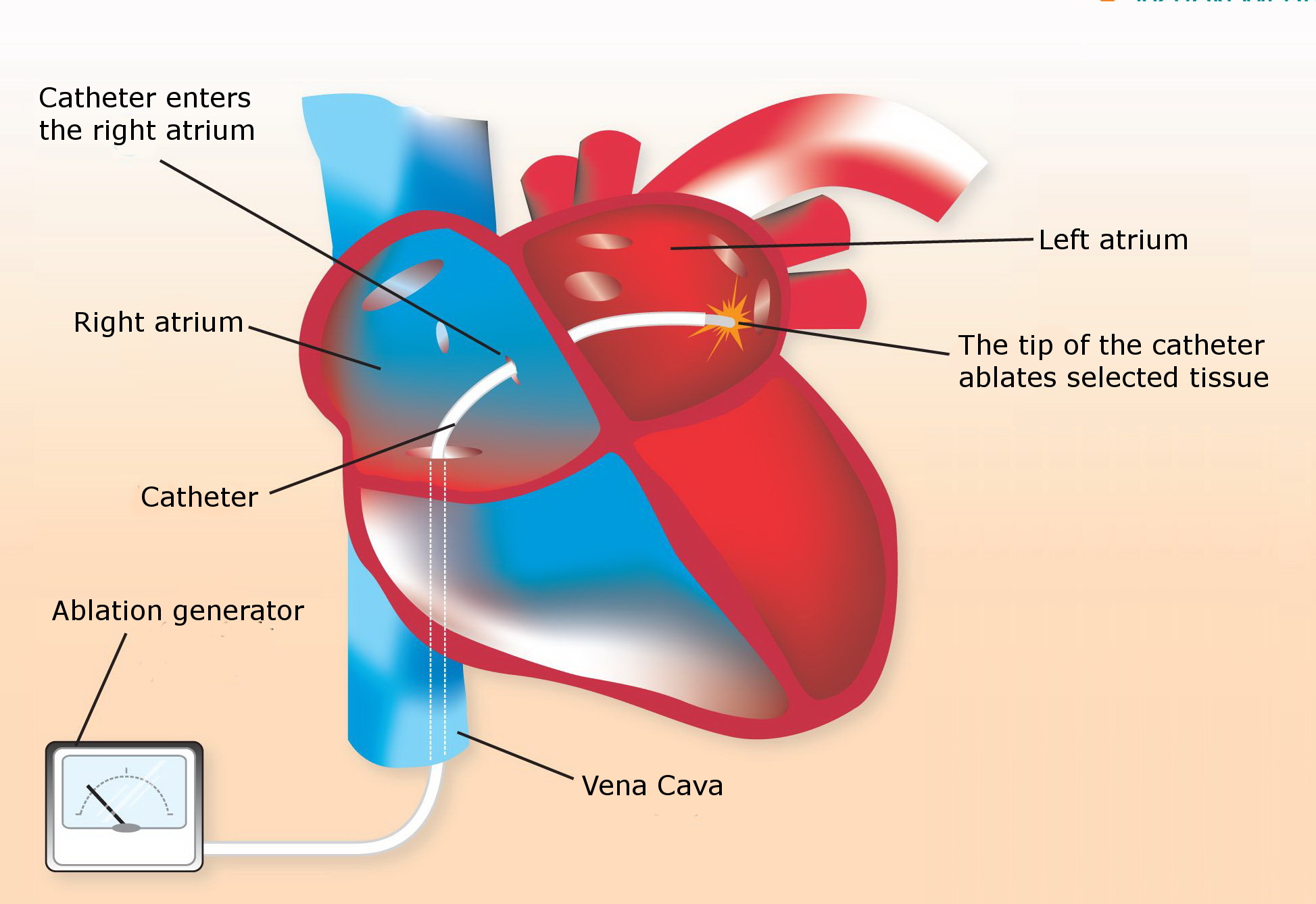 travel after heart ablation